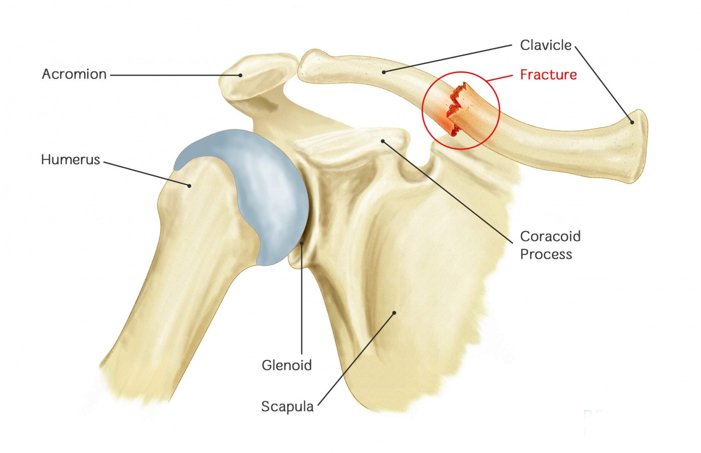 CLAVICLE FRACTURE